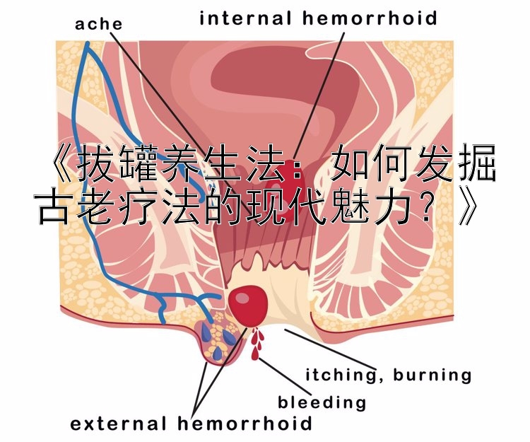 《拔罐养生法：如何发掘古老疗法的现代魅力？》